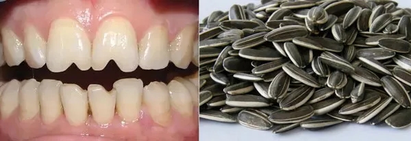 有一种牙齿缺损叫“瓜子牙”